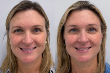Botox Before and After Photos in Miami Beach, FL, Patient 9395