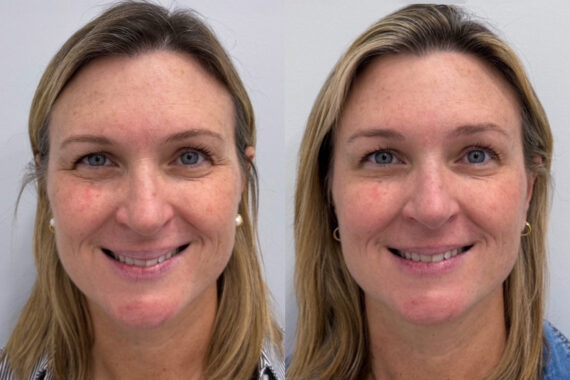 Botox Before and After Photos in Miami Beach, FL, Patient 9395