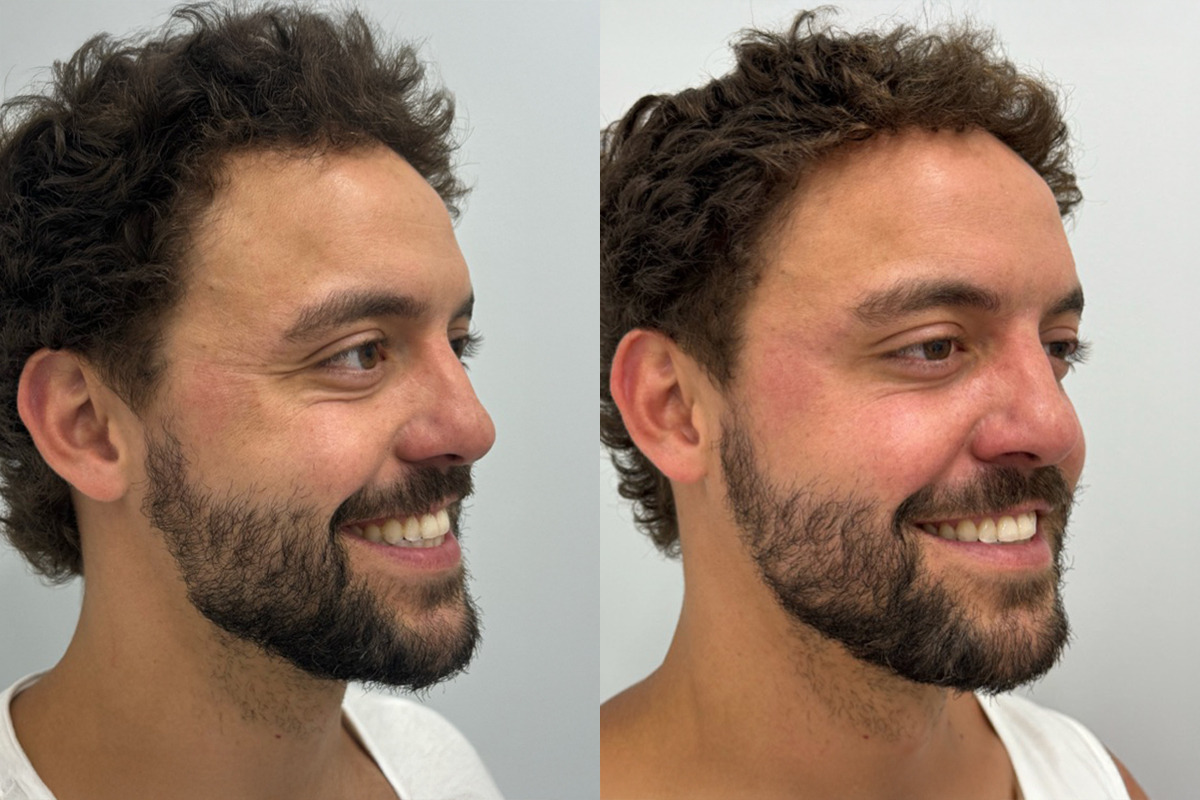 Botox Before and After Photos in Miami Beach, FL, Patient 9422