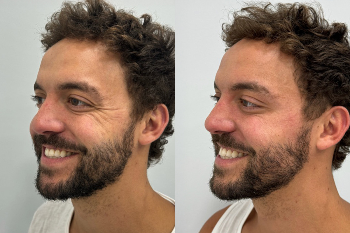 Botox Before and After Photos in Miami Beach, FL, Patient 9422