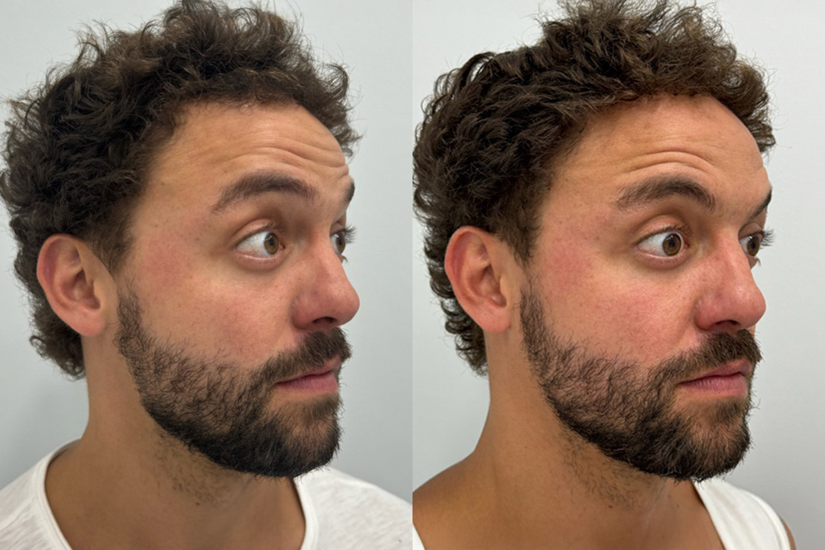 Botox Before and After Photos in Miami Beach, FL, Patient 9422
