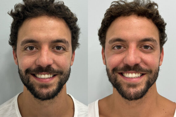 Botox Before and After Photos in Miami Beach, FL, Patient 9422