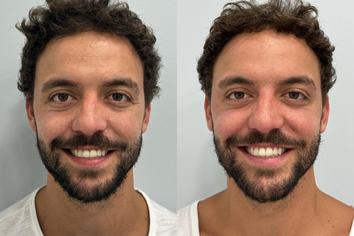 Botox Before and After Photos in Miami Beach, FL, Patient 9422
