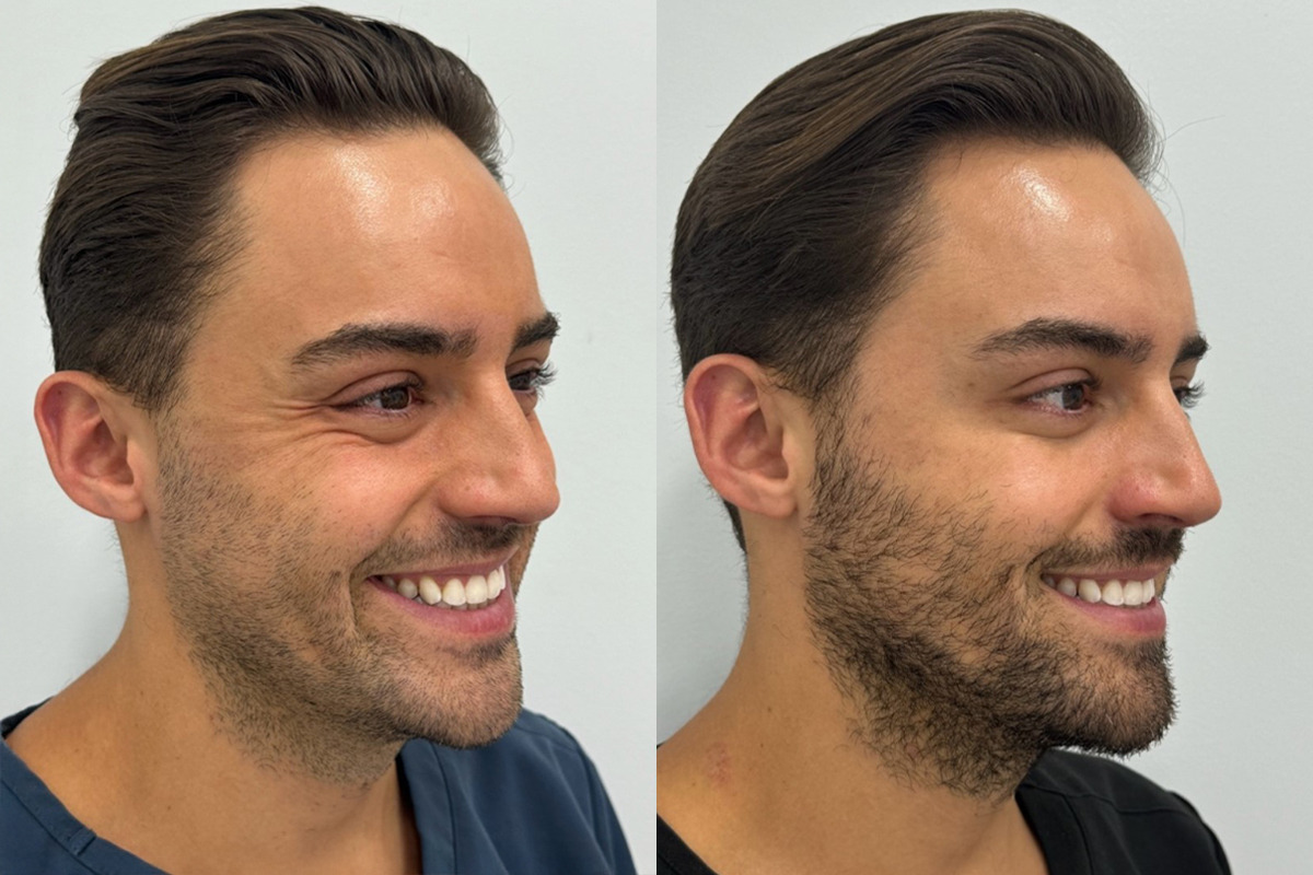 Botox Before and After Photos in Miami Beach, FL, Patient 9435