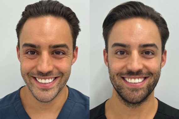 Botox Before and After Photos in Miami Beach, FL, Patient 9435