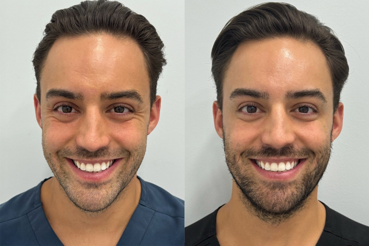 Botox Before and After Photos in Miami Beach, FL, Patient 9435