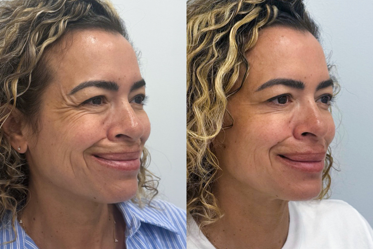 Botox Before and After Photos in Miami Beach, FL, Patient 9442