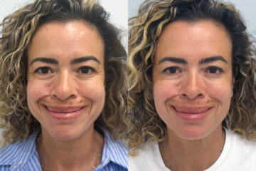 Botox Before and After Photos in Miami Beach, FL, Patient 9442