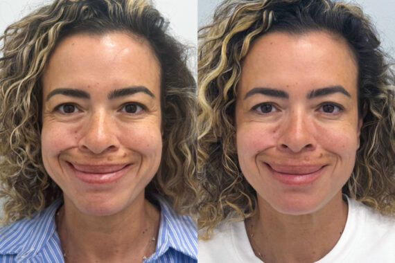 Botox Before and After Photos in Miami Beach, FL, Patient 9442
