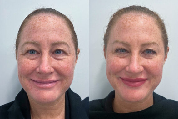 Botox Before and After Photos in Miami Beach, FL, Patient 9450