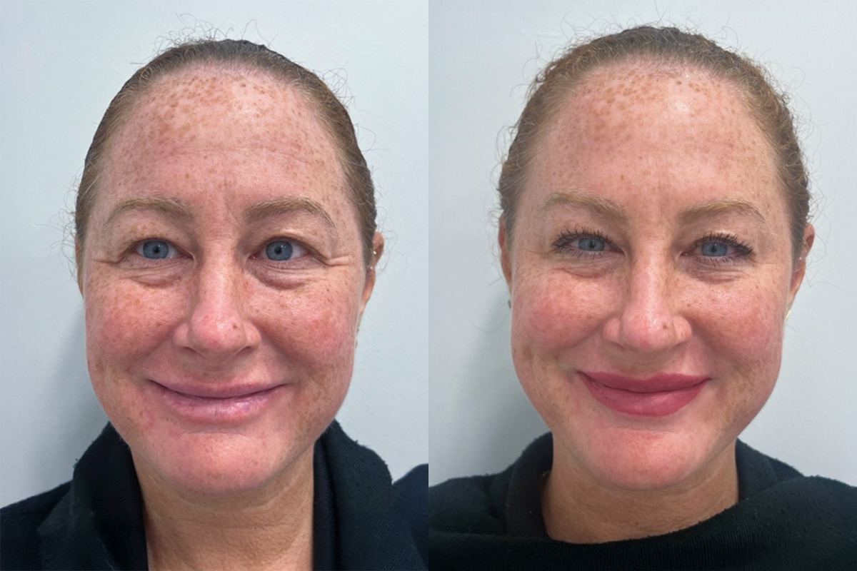 Botox Before and After Photos in Miami Beach, FL, Patient 9450