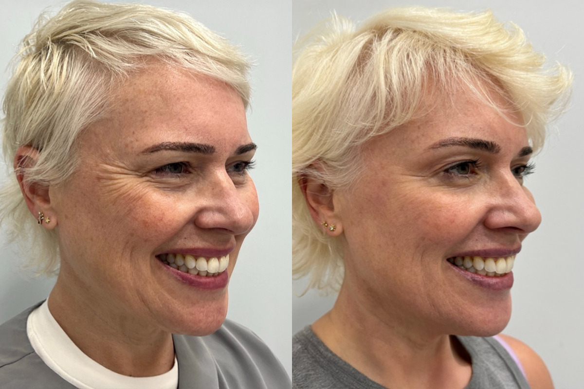 Botox Before and After Photos in Miami Beach, FL, Patient 9457