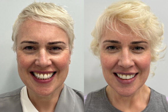 Botox Before and After Photos in Miami Beach, FL, Patient 9457