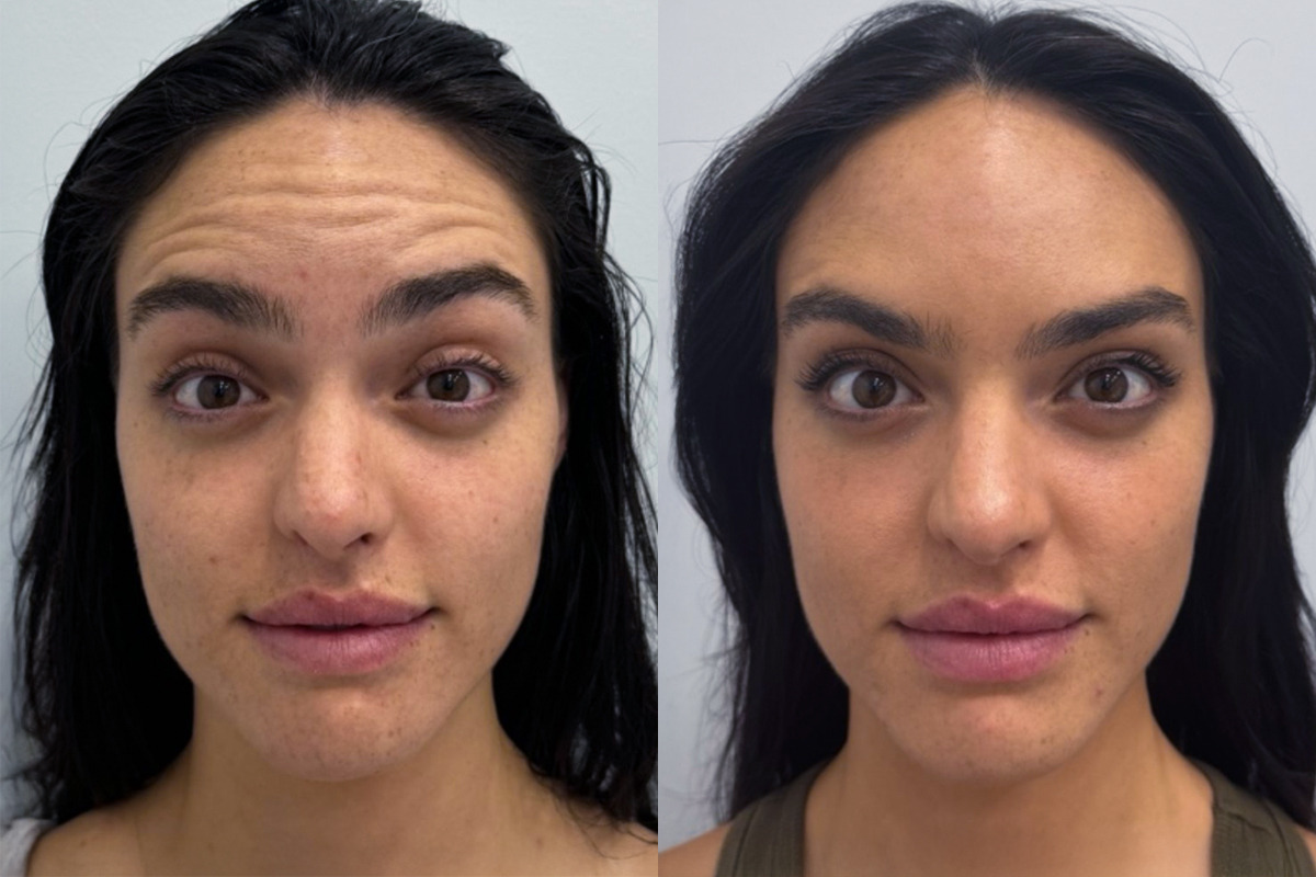 Botox Before and After Photos in Miami Beach, FL, Patient 9464