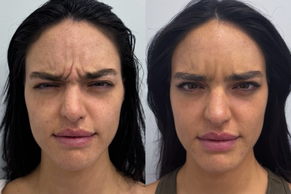 Botox Before and After Photos in Miami Beach, FL, Patient 9464