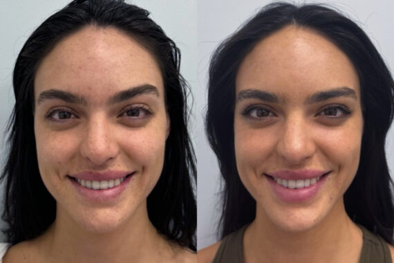 Botox Before and After Photos in Miami Beach, FL, Patient 9464