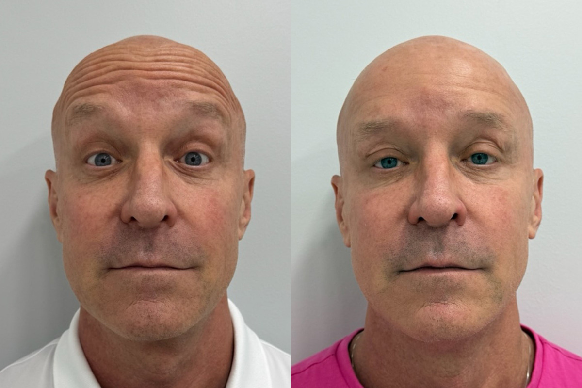 Botox Before and After Photos in Miami Beach, FL, Patient 9474