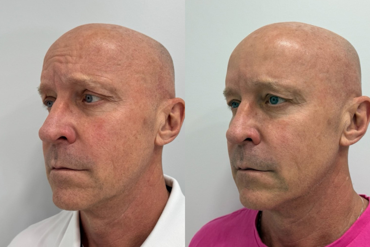 Botox Before and After Photos in Miami Beach, FL, Patient 9474
