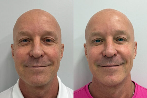 Botox Before and After Photos in Miami Beach, FL, Patient 9474