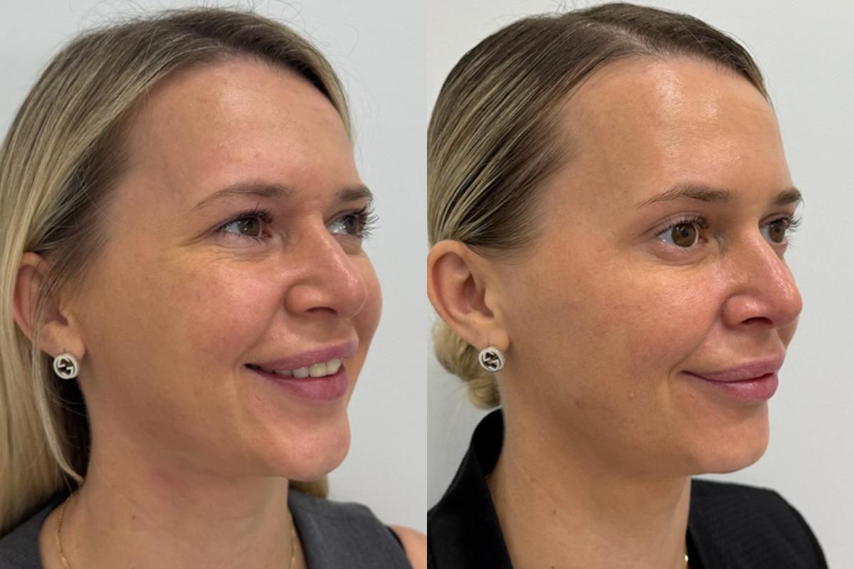 Botox Before and After Photos in Miami Beach, FL, Patient 9484
