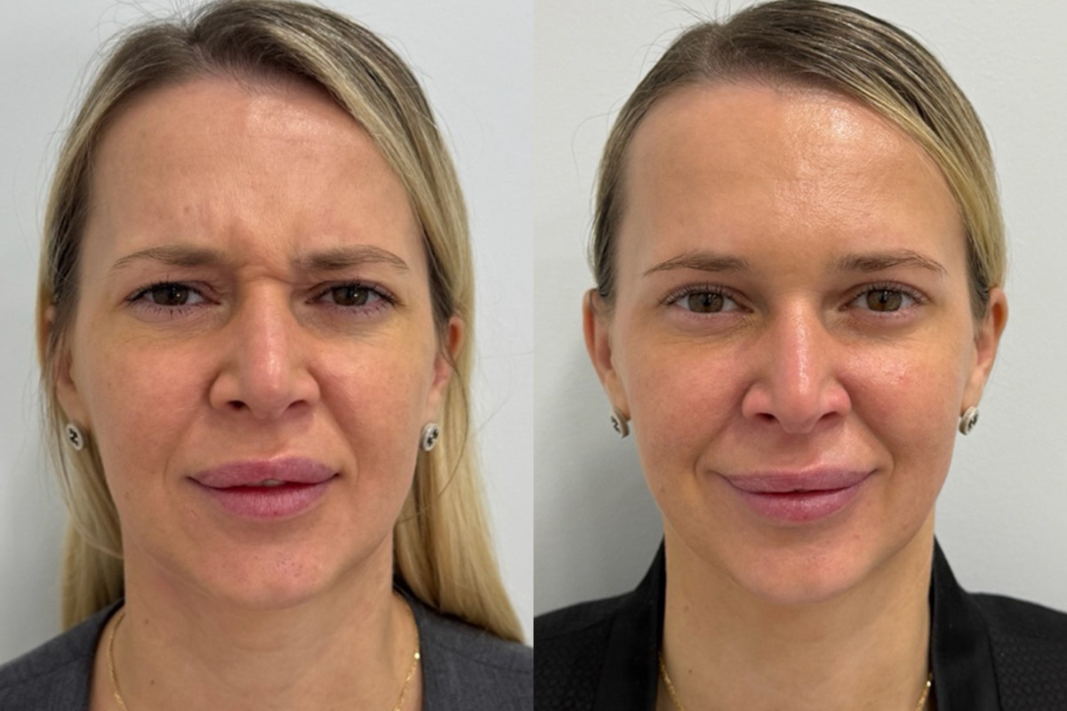 Botox Before and After Photos in Miami Beach, FL, Patient 9484