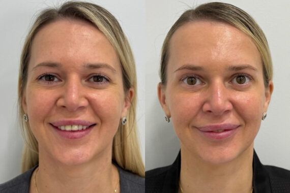 Botox Before and After Photos in Miami Beach, FL, Patient 9484