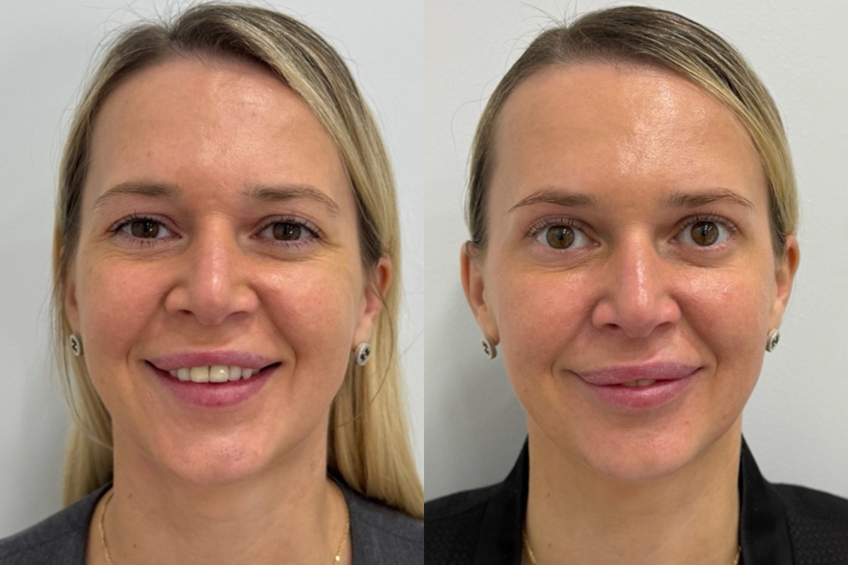 Botox Before and After Photos in Miami Beach, FL, Patient 9484