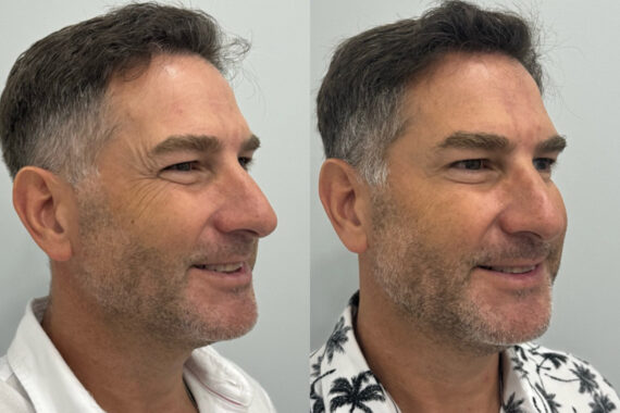 Botox Before and After Photos in Miami Beach, FL, Patient 9496