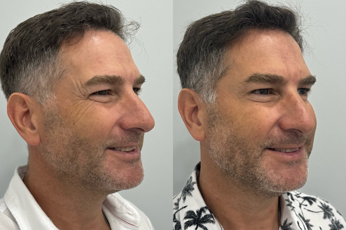 Botox Before and After Photos in Miami Beach, FL, Patient 9496