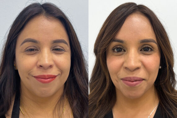 Botox Before and After Photos in Miami Beach, FL, Patient 9500