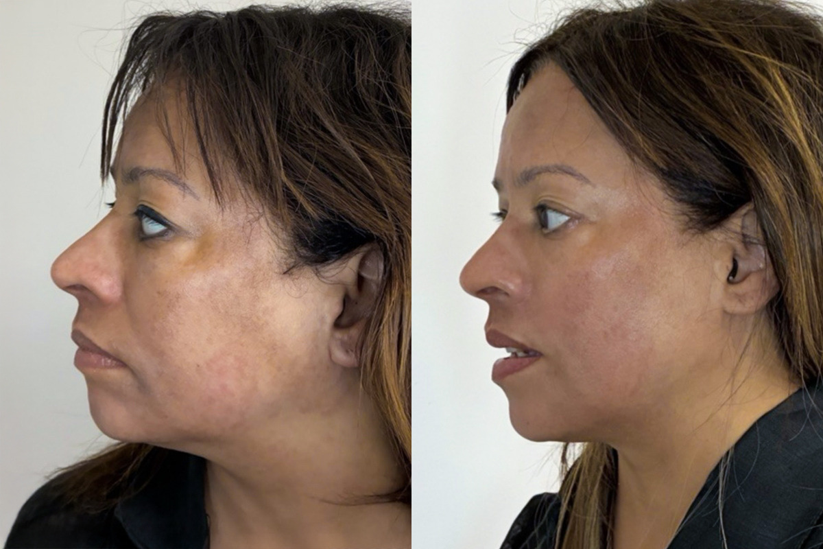 Cold Plasma Before and After Photos in Miami Beach, FL, Patient 9967