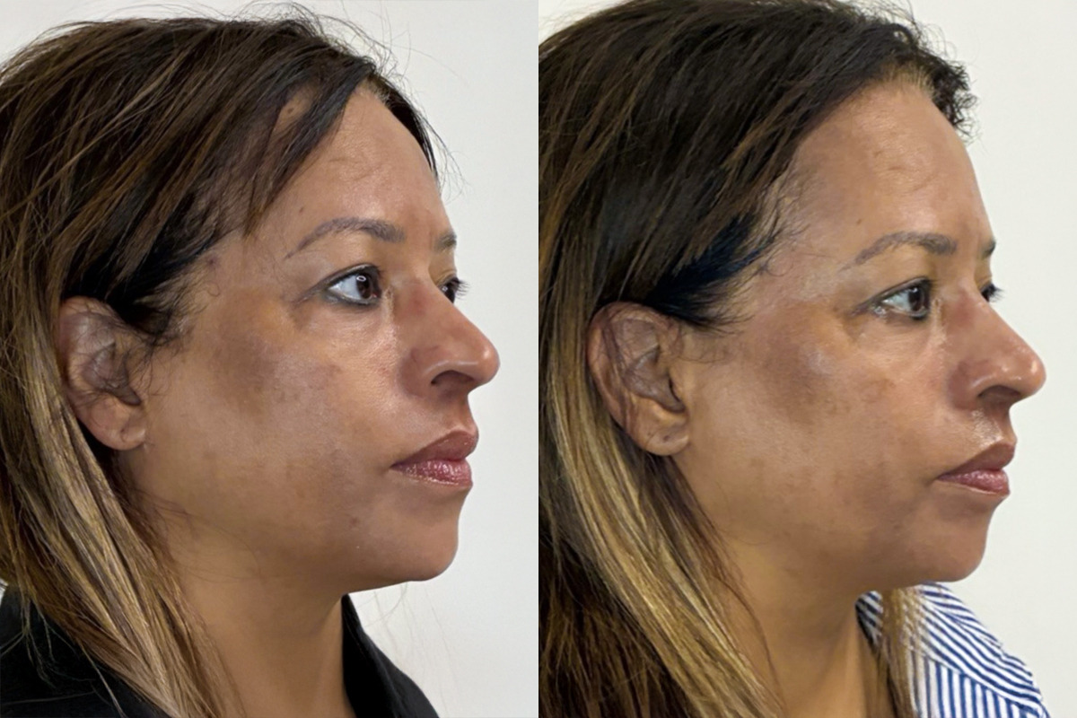 Cold Plasma Before and After Photos in Miami Beach, FL, Patient 9967