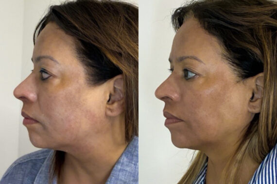 Cold Plasma Before and After Photos in Miami Beach, FL, Patient 9967