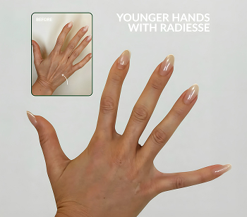 radiesse on hands at bodywelle