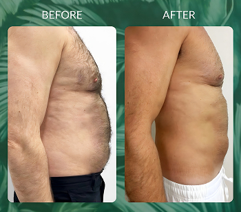 Emsculpt neo before and after