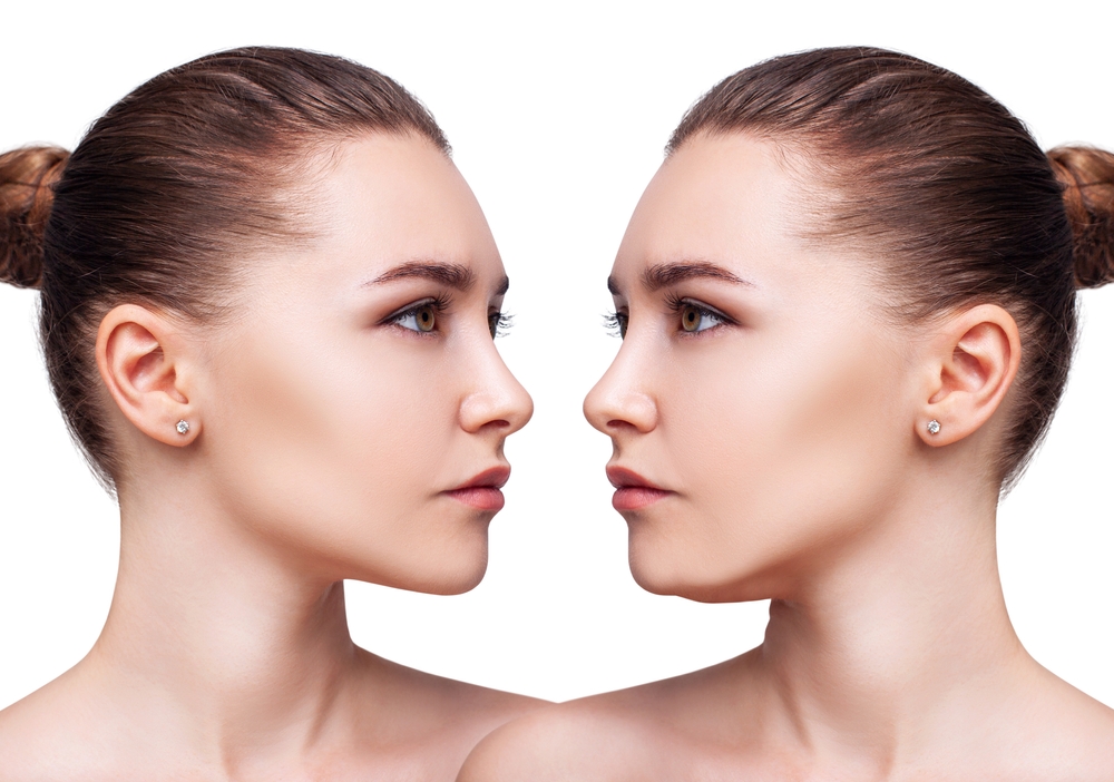 Side-by-side comparison of a woman's face showing skin tightening and contour improvement from Morpheus8 treatment.