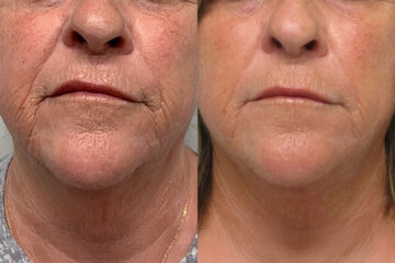 Morpheus8 Before and After Photos in Miami Beach, FL, Patient 10750