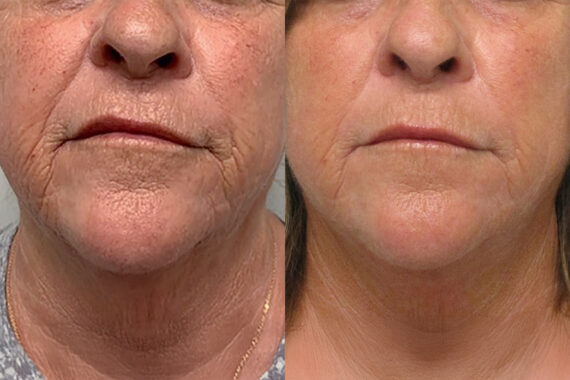 Morpheus8 Before and After Photos in Miami Beach, FL, Patient 10750
