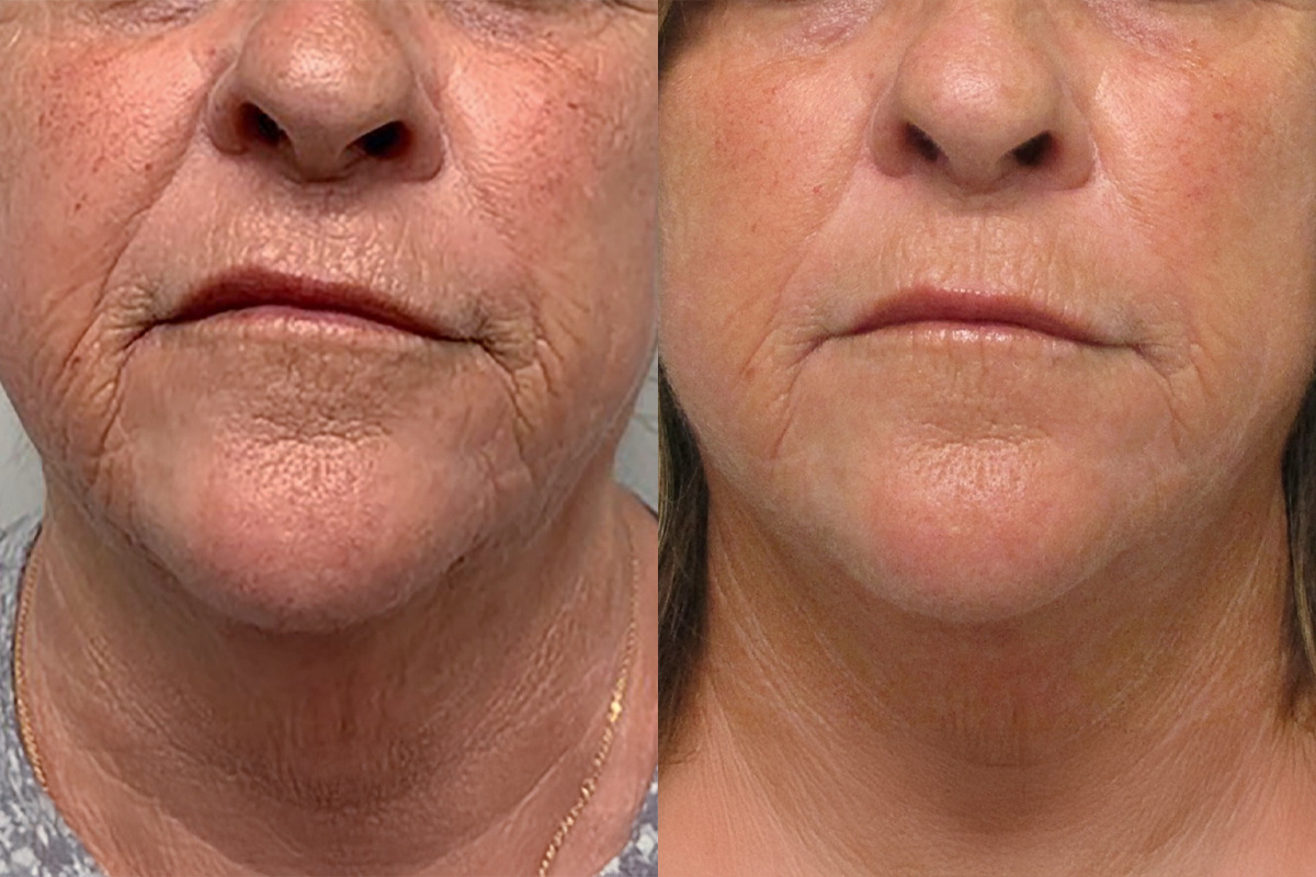 Morpheus8 Before and After Photos in Miami Beach, FL, Patient 10750