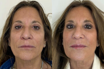Morpheus8 Before and After Photos in Miami Beach, FL, Patient 10754