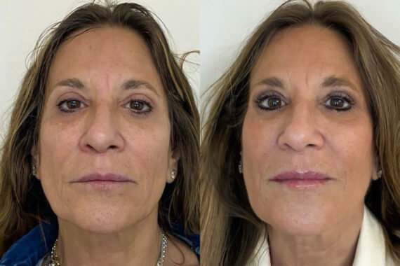 Morpheus8 Before and After Photos in Miami Beach, FL, Patient 10754