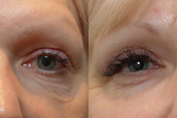 Morpheus8 Before and After Photos in Miami Beach, FL, Patient 10758