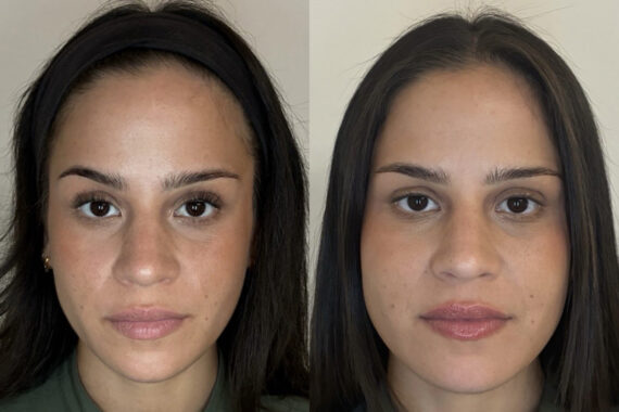 Botox Before and After Photos in Miami Beach, FL, Patient 10798