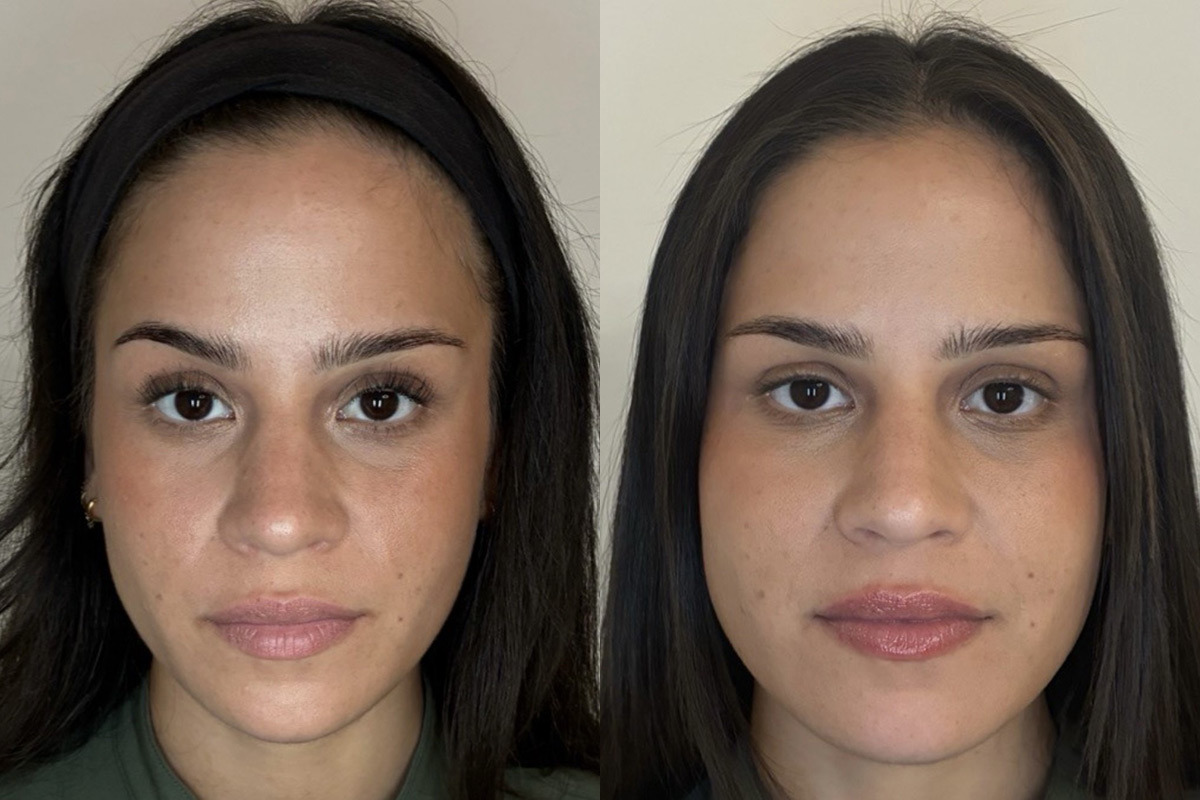 Botox Before and After Photos in Miami Beach, FL, Patient 10798