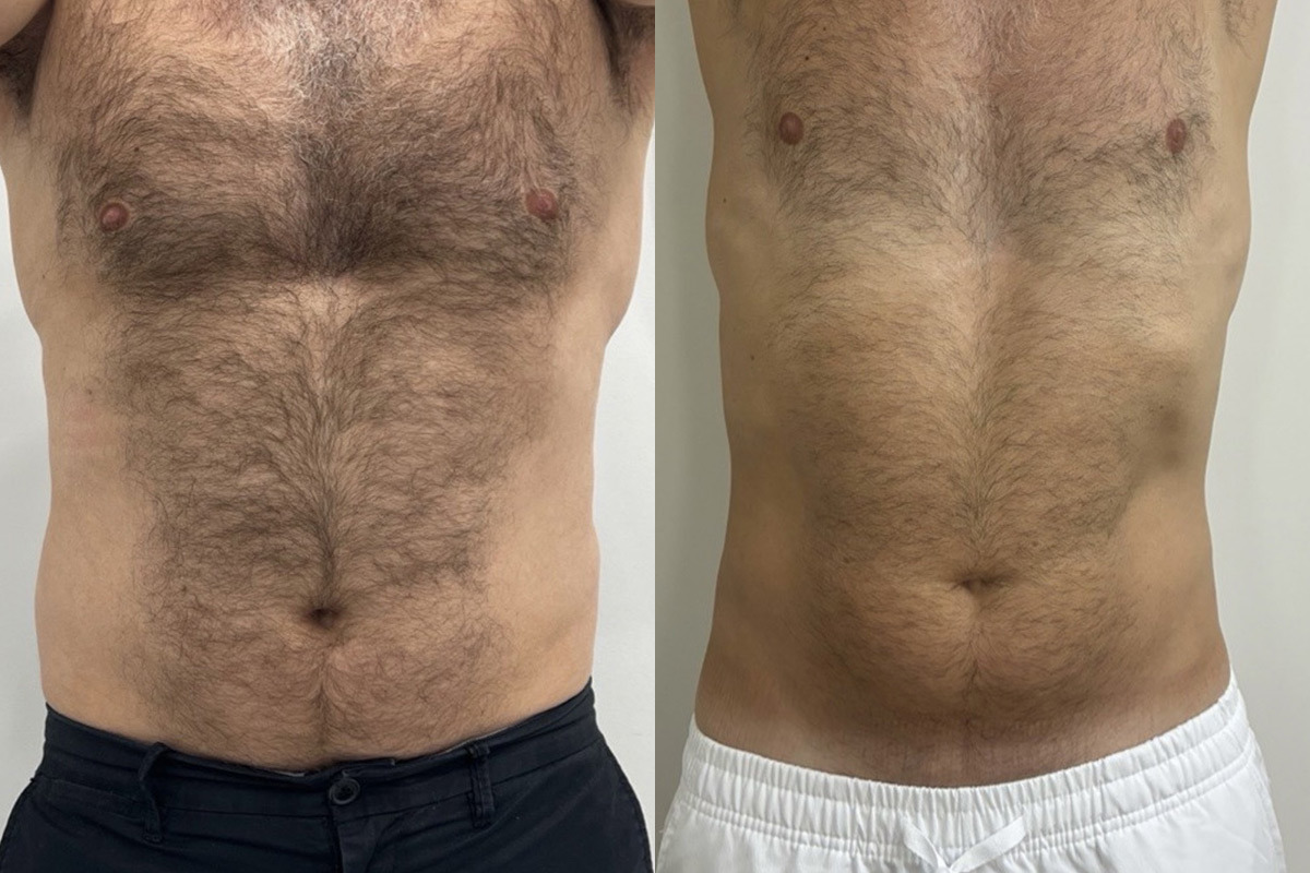 EMSculpt NEO Before and After Photos in Miami Beach, FL, Patient 10811