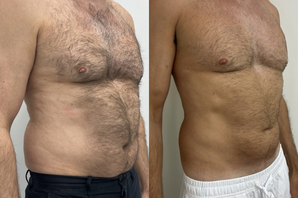 EMSculpt NEO Before and After Photos in Miami Beach, FL, Patient 10811