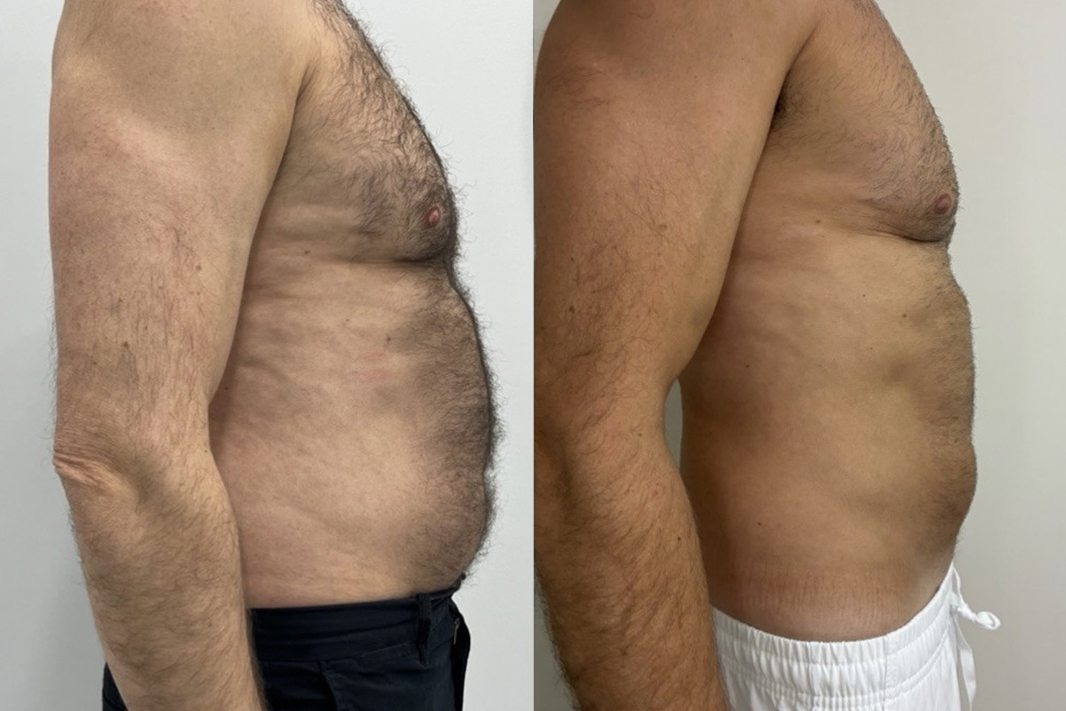 EMSculpt NEO Before and After Photos in Miami Beach, FL, Patient 10811