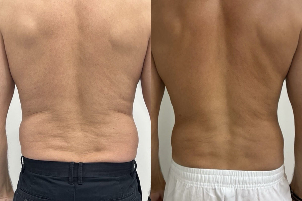 EMSculpt NEO Before and After Photos in Miami Beach, FL, Patient 10811