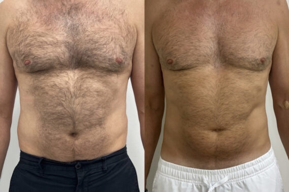 EMSculpt NEO Before and After Photos in Miami Beach, FL, Patient 10811