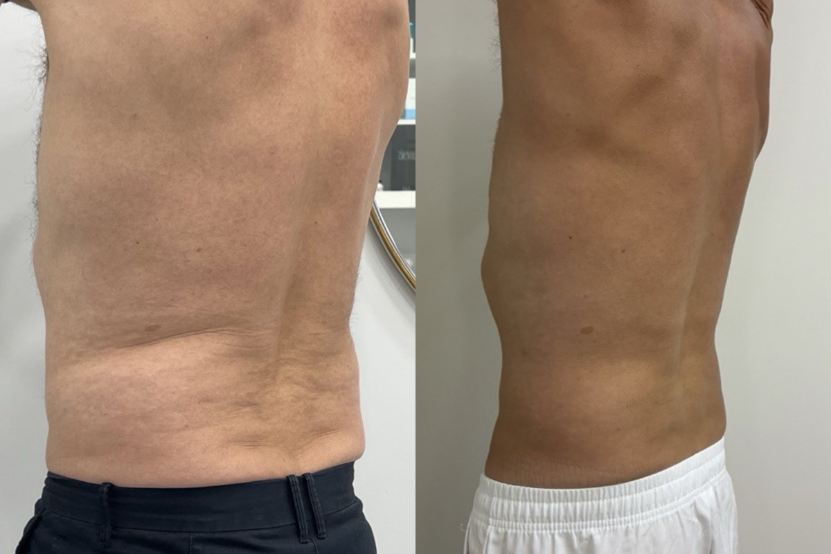 EMSculpt NEO Before and After Photos in Miami Beach, FL, Patient 10811